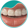 botao-A2-aparelhos-esteticos-ortodontia-aparelhos-invisiveis-dra-sandra-vicente-barra-da-tijuca-clinica-faceortoto-ortodontia-invisalign-aparelhos-invisiveis2